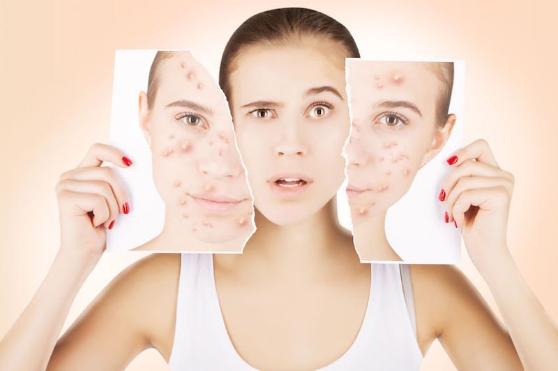 girl breaks portrait with her pimpled skin